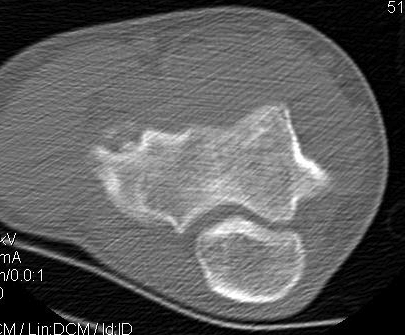 Elbow OCD Type 2B CT